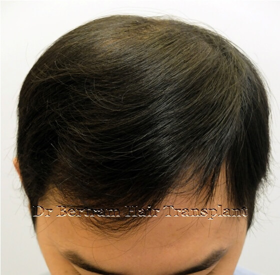 hair transplant before and after picture men