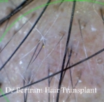 alopecia areata