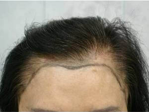 female hair transplant