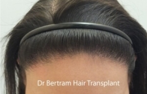 female hair transplant