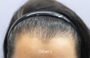 female hair transplant