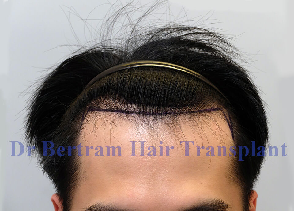 fue transplant