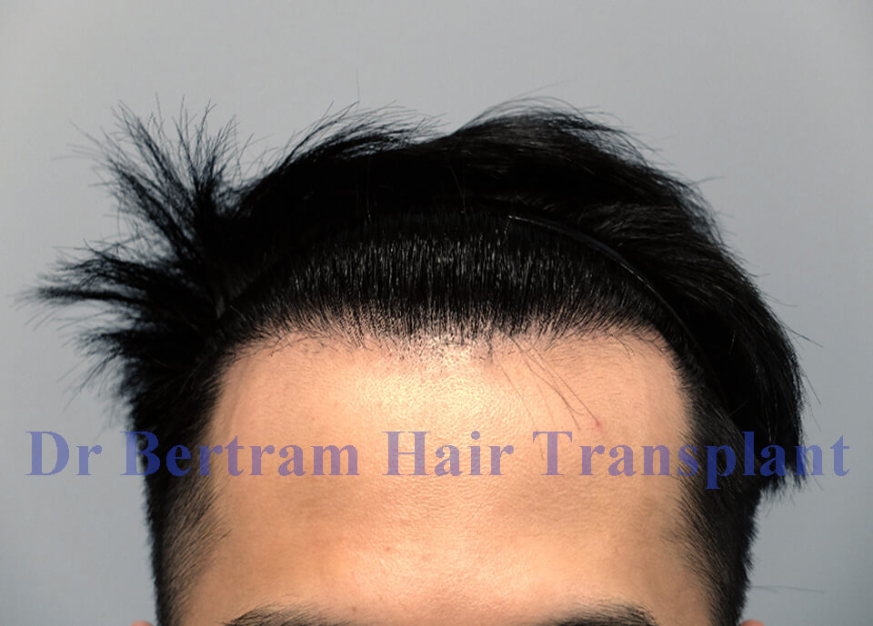 fue transplant