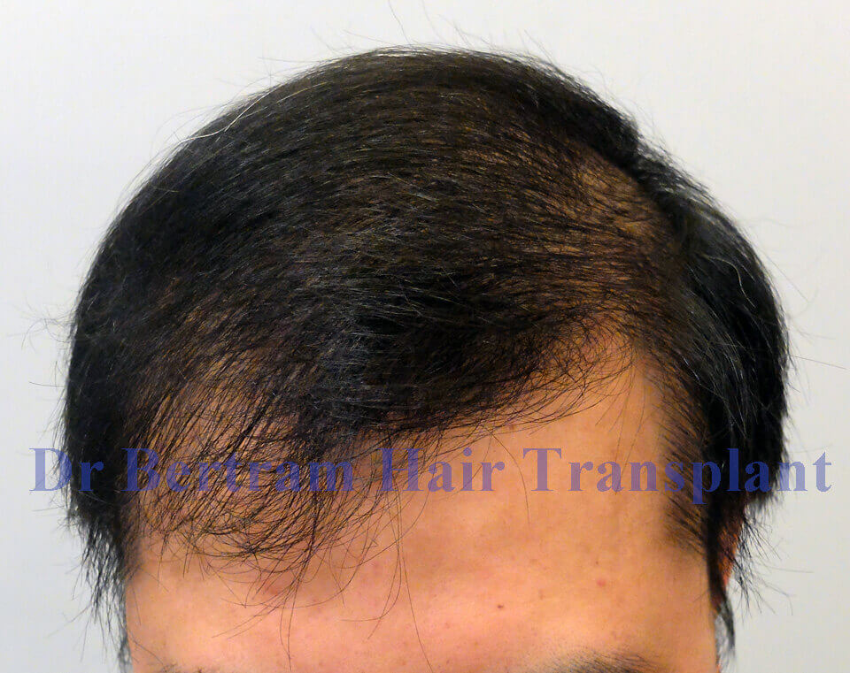 fue transplant