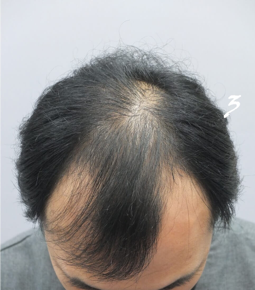 Side of Head (Donor Zone)