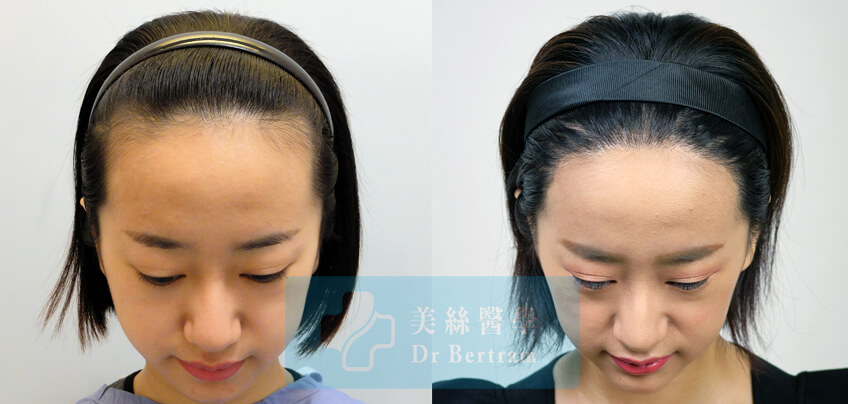 female hair transplant