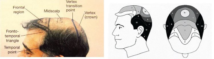 Surgical strategy for crown