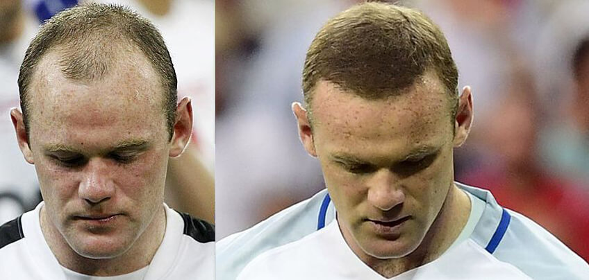 hair transplant how does it work