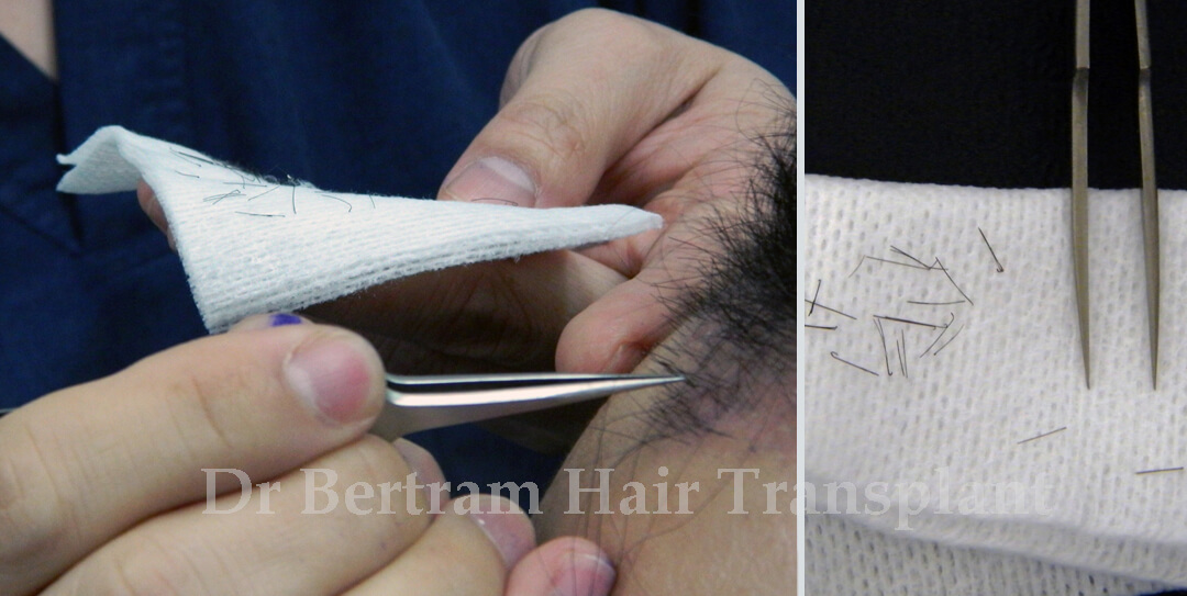Swimming after hair transplant