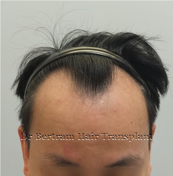 術前：正面角度，IV期脫髮模式