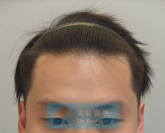 術後12個月：髮際線恢復