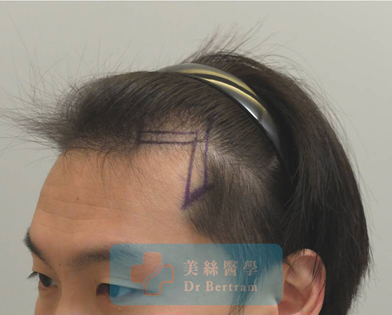 術前：側面顳部後移