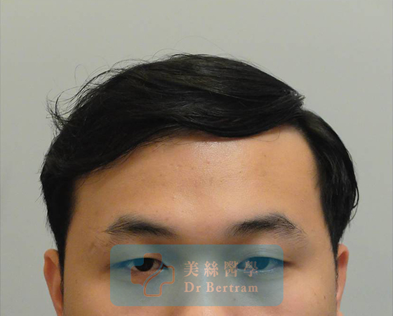 術後12個月：髮際線恢復