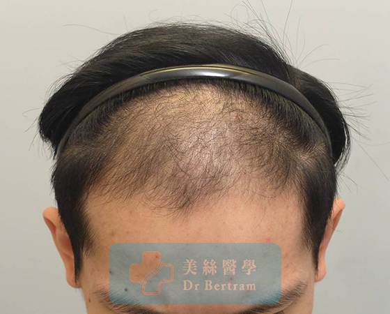 術前：頭頂中部可見稀疏