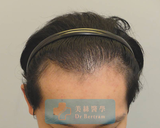 術後：覆蓋改善