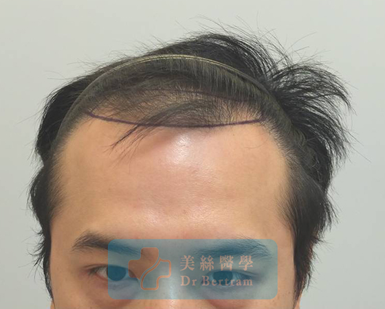 術前：IIIa期前額髮際線上移