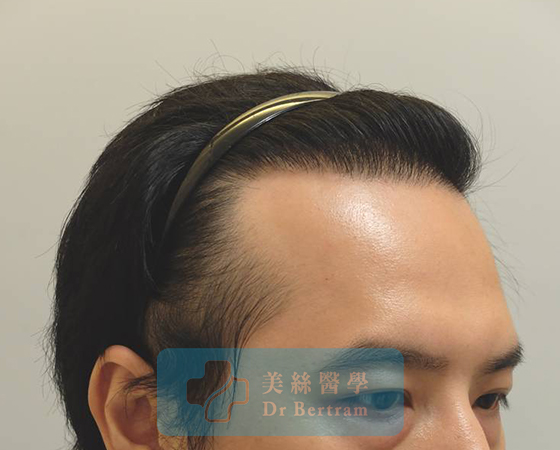 12 months post-procedure: Temporal restoration
