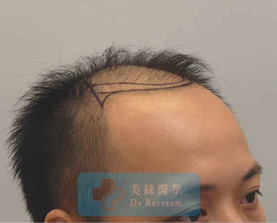 術前：Va期前額髮際線上移
