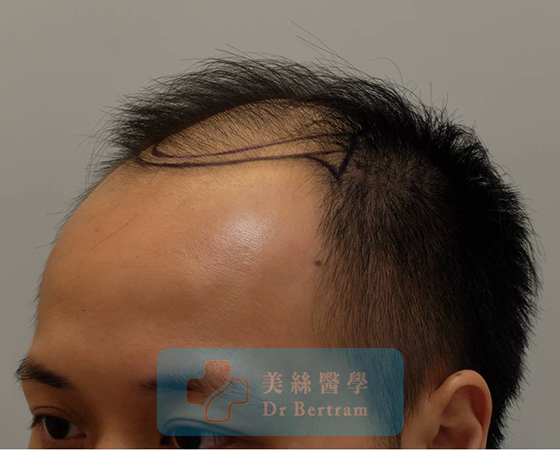 術前：頭頂角度顯示廣泛稀疏