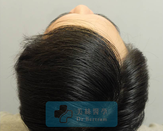 術後：顳部連接恢復