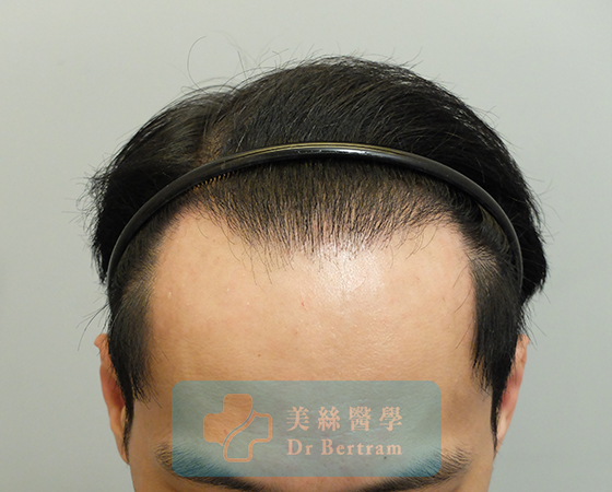 術後12個月：髮際線恢復