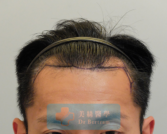 術前：III期前額髮際線上移