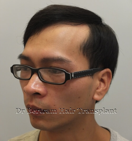 術後12個月：頭頂角度