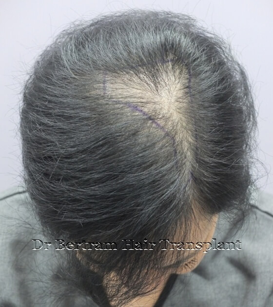 個案2 女性術前：分界線及頭頂稀疏