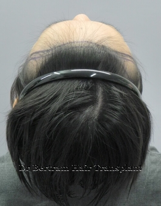 術前：側面角度3