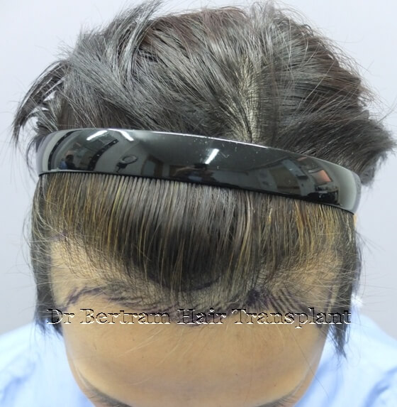 術前：頭頂角度顯示稀疏