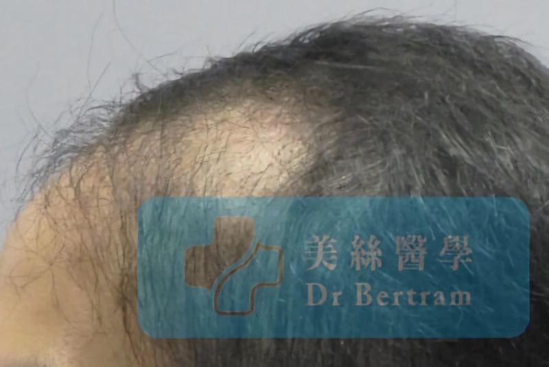 Low hairline revision