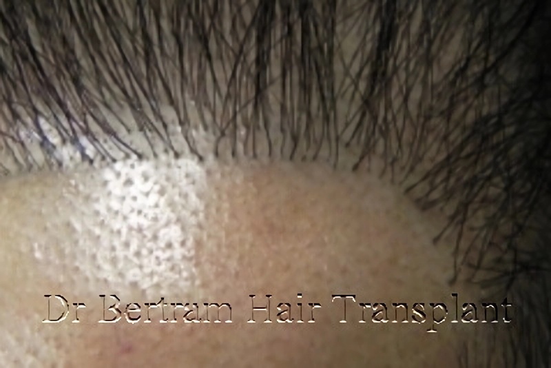 Hairline revision