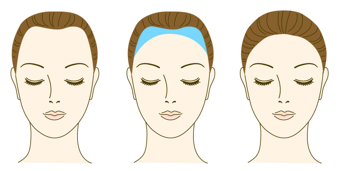 Female hairline design principles